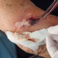Clean Air and Healing: Understanding What Is Fibrinous Exudate Tissue in a Wound