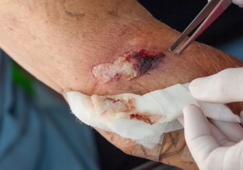 Clean Air and Healing: Understanding What Is Fibrinous Exudate Tissue in a Wound